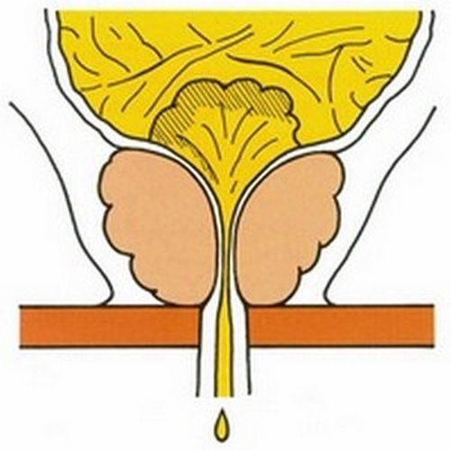 Incontinence urinaire : vessie neurogène, causes traitement
