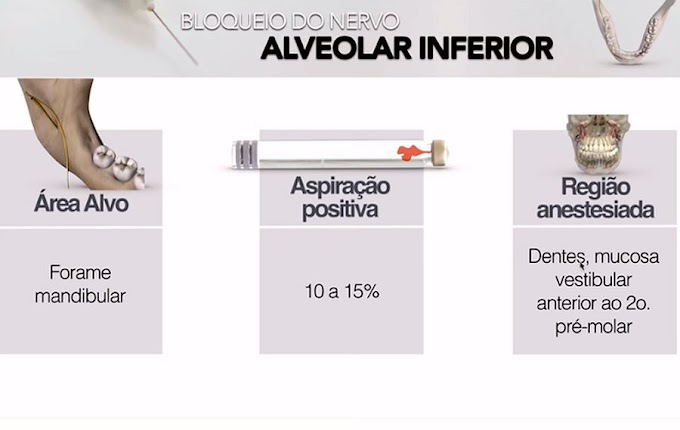 ANESTESIA DENTAL: Passo-a-Passo do Bloqueio do Nervo Alveolar Inferior - Prof Fernando Giovanella