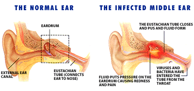 Ear Infection (Otitis Externa). About Ear Infections | Patient