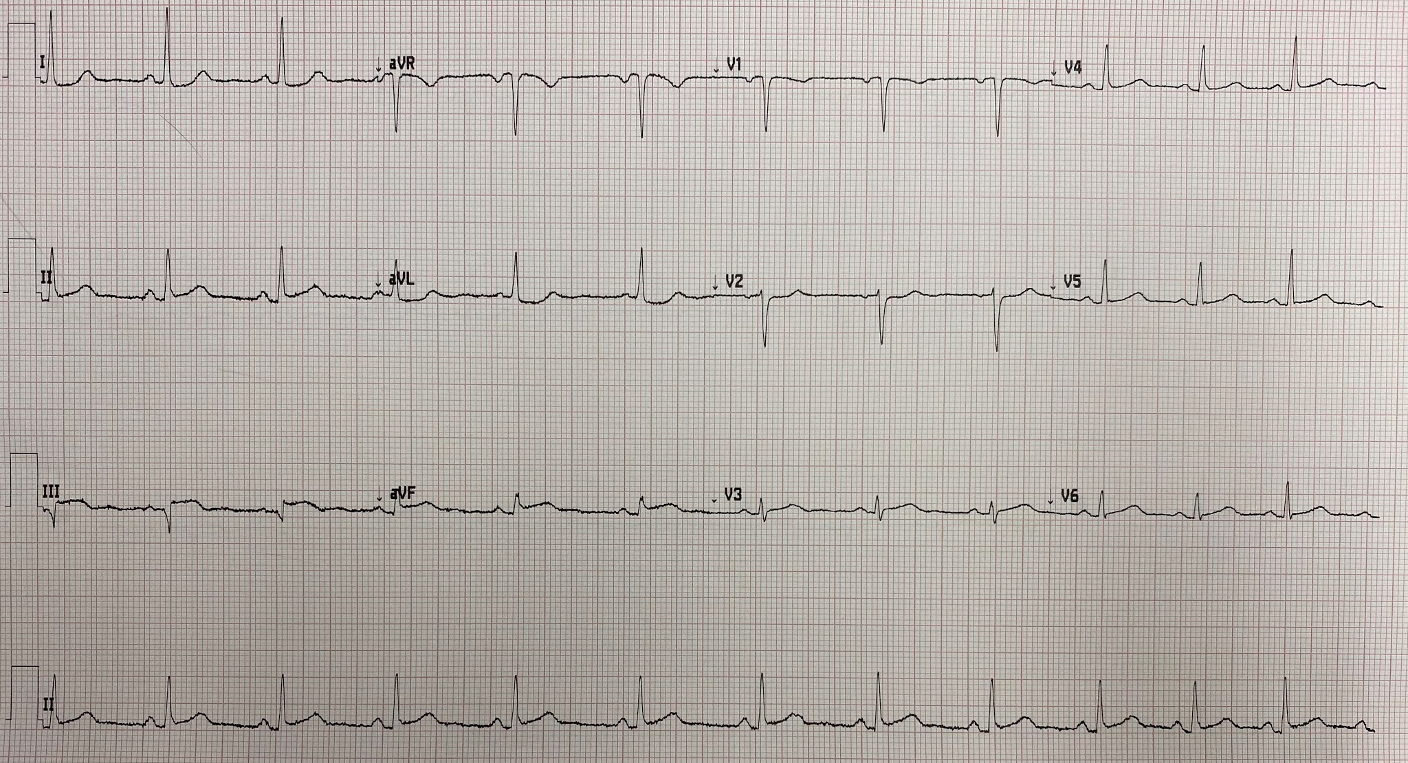 Dr. Smith's ECG Blog This patient with "NSTEMI" was not allowed to go