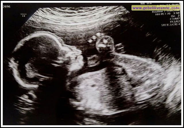 20 haftalık gebelik ultrason görüntüsü