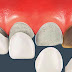 Bọc răng sứ titan duy trì bao lâu?