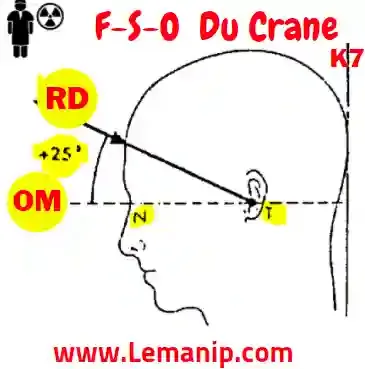 Incidence De F-S-O  Du Crane (WORMS et BRETTON)
