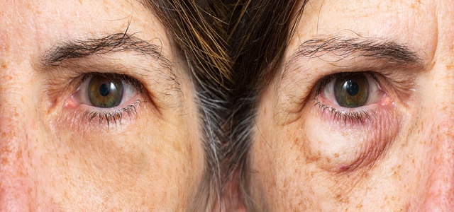 Tips for Using Skin Care for Eyes