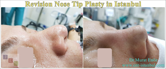 Revision Aesthetic Nose Tip Surgery,Revision Nose Tip Plasty in Istanbul,