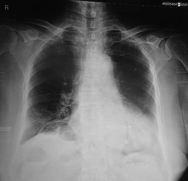 VIETNAMESE MEDIC ULTRASOUND CASE 202 BOWEL OBSTRUCTION, Dr PHAN THANH