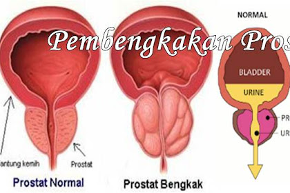 Obat Herbal Pembengkakan Prostat