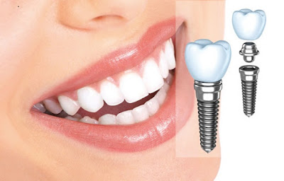 Dịch vụ trồng răng implant ở cần thơ-1