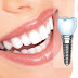 Dịch vụ trồng răng implant ở cần thơ