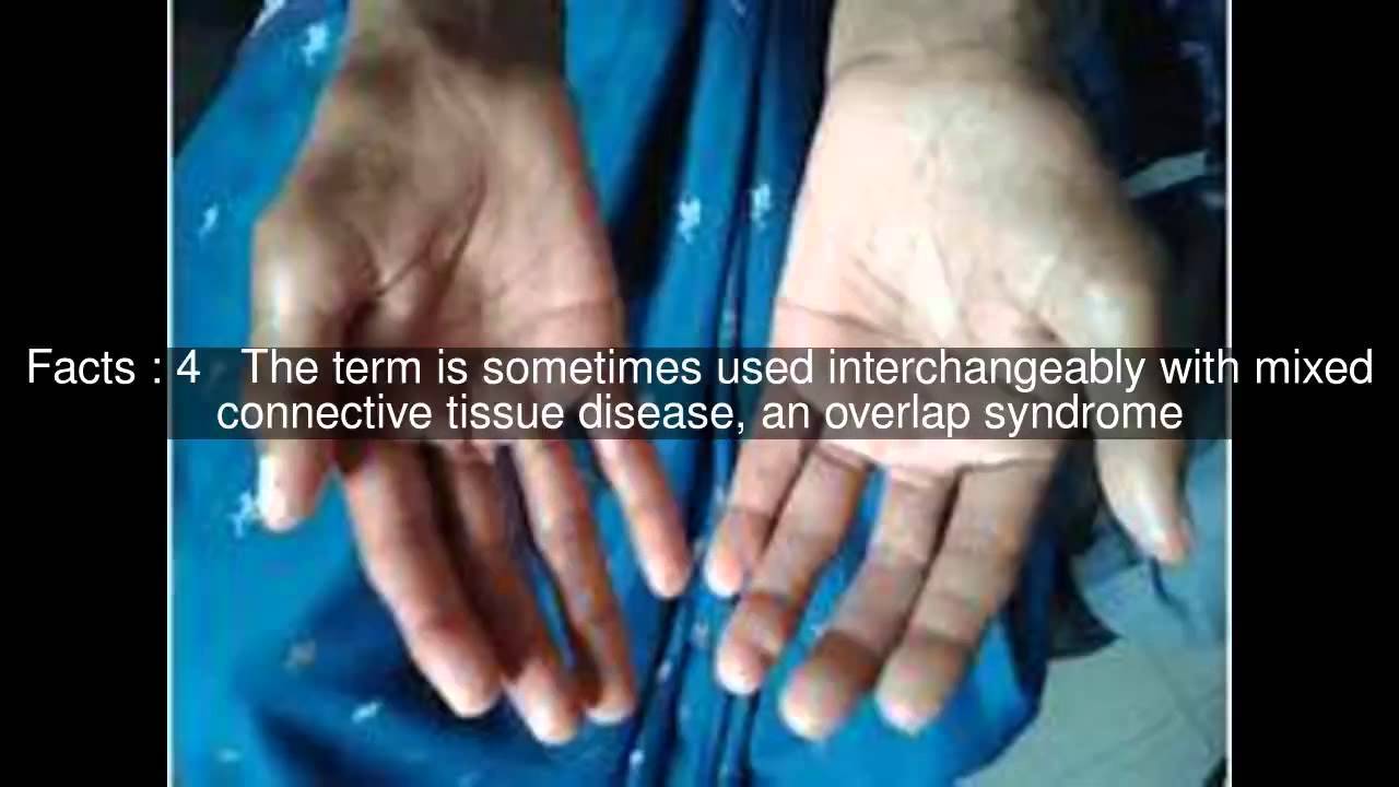 Undifferentiated connective tissue disease