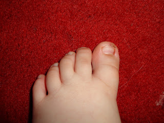 Big Boy's toe after the book damage