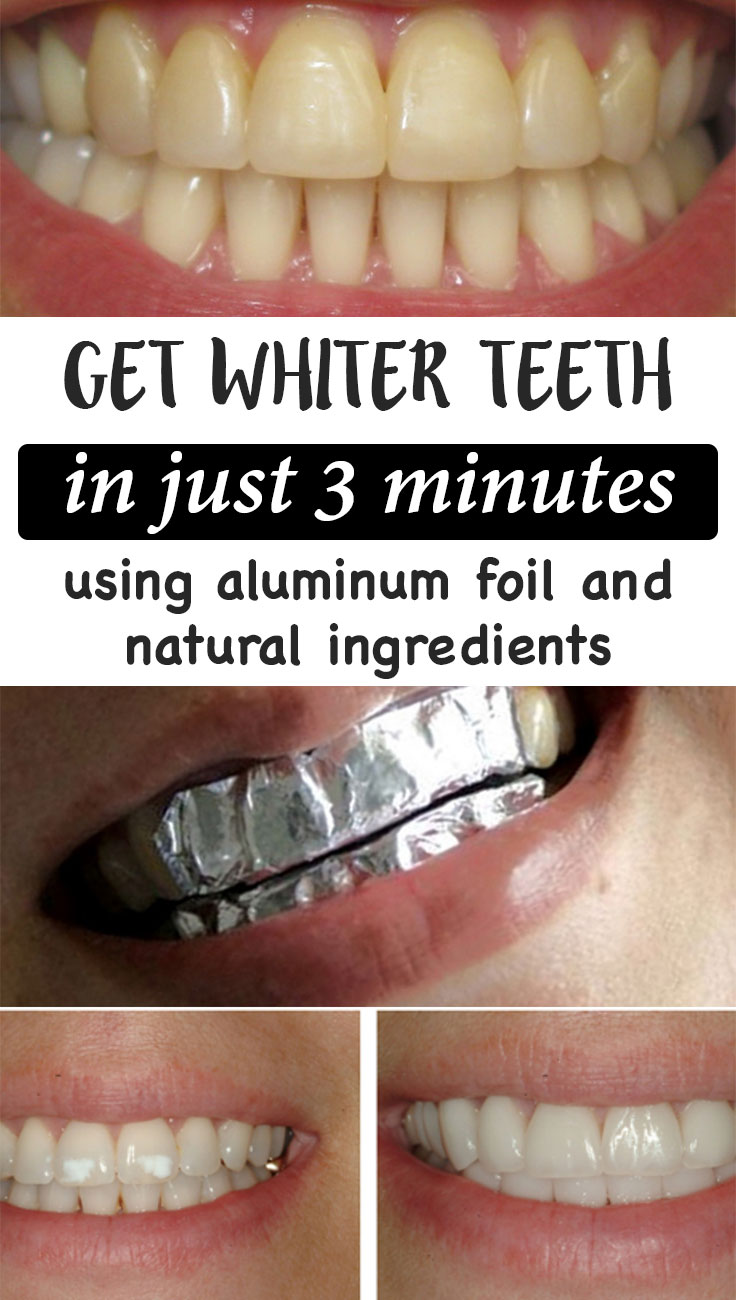 Get whiter teeth in just 3 minutes using aluminum foil and natural