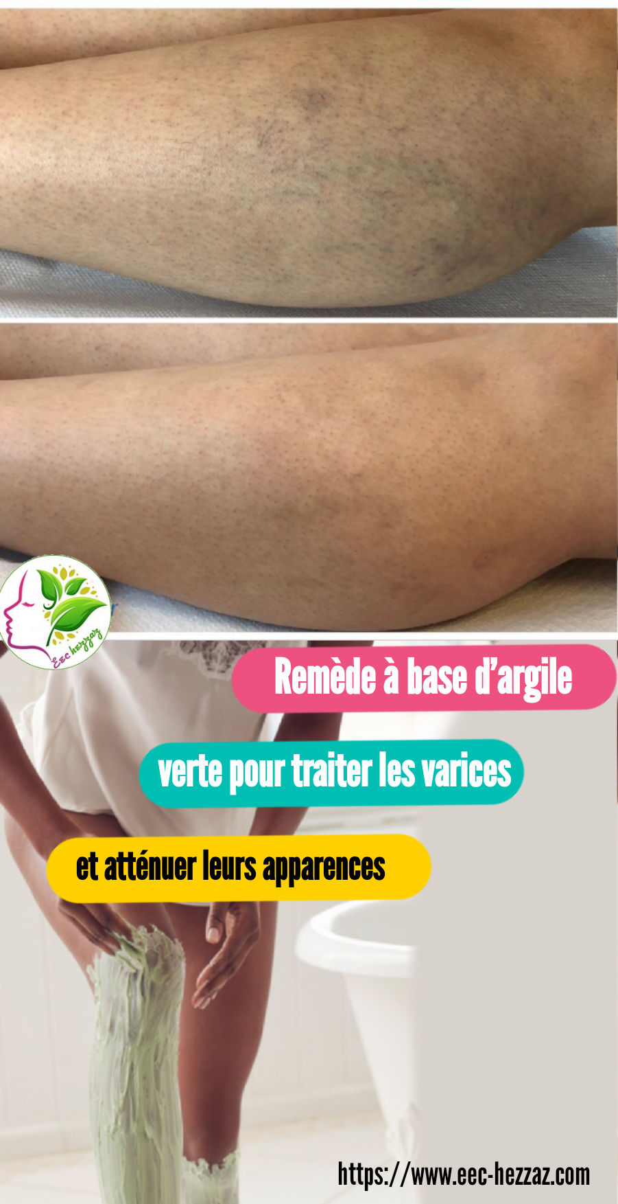 Remède à base d’argile verte pour traiter les varices et atténuer leurs apparences