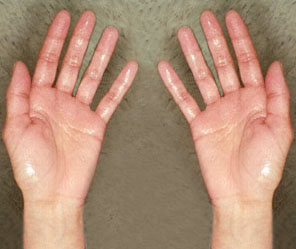 HIPERHIDROSIS PALMAR TRATAMIENTO PDF