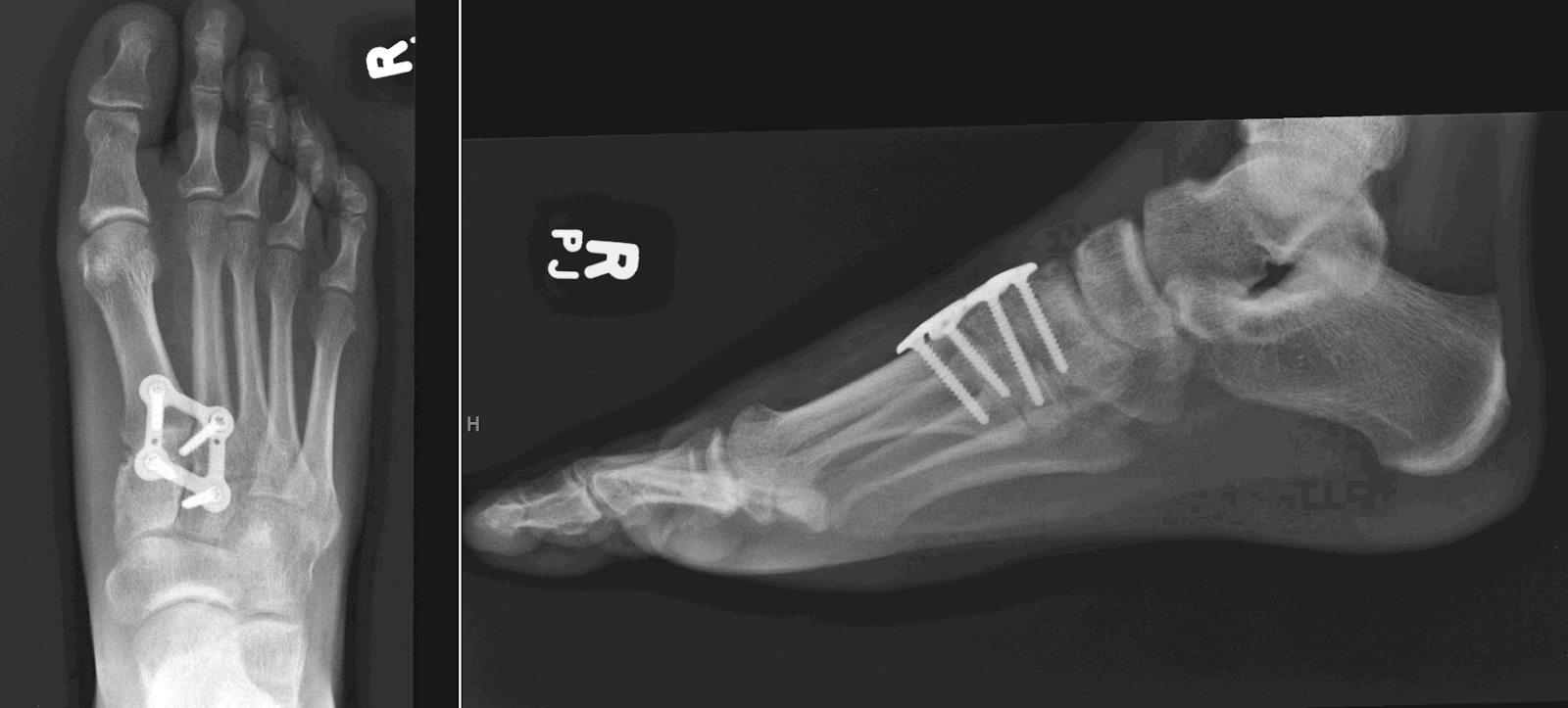 www.lisfranc.ca Lisfranc Fracture / Injury Blog