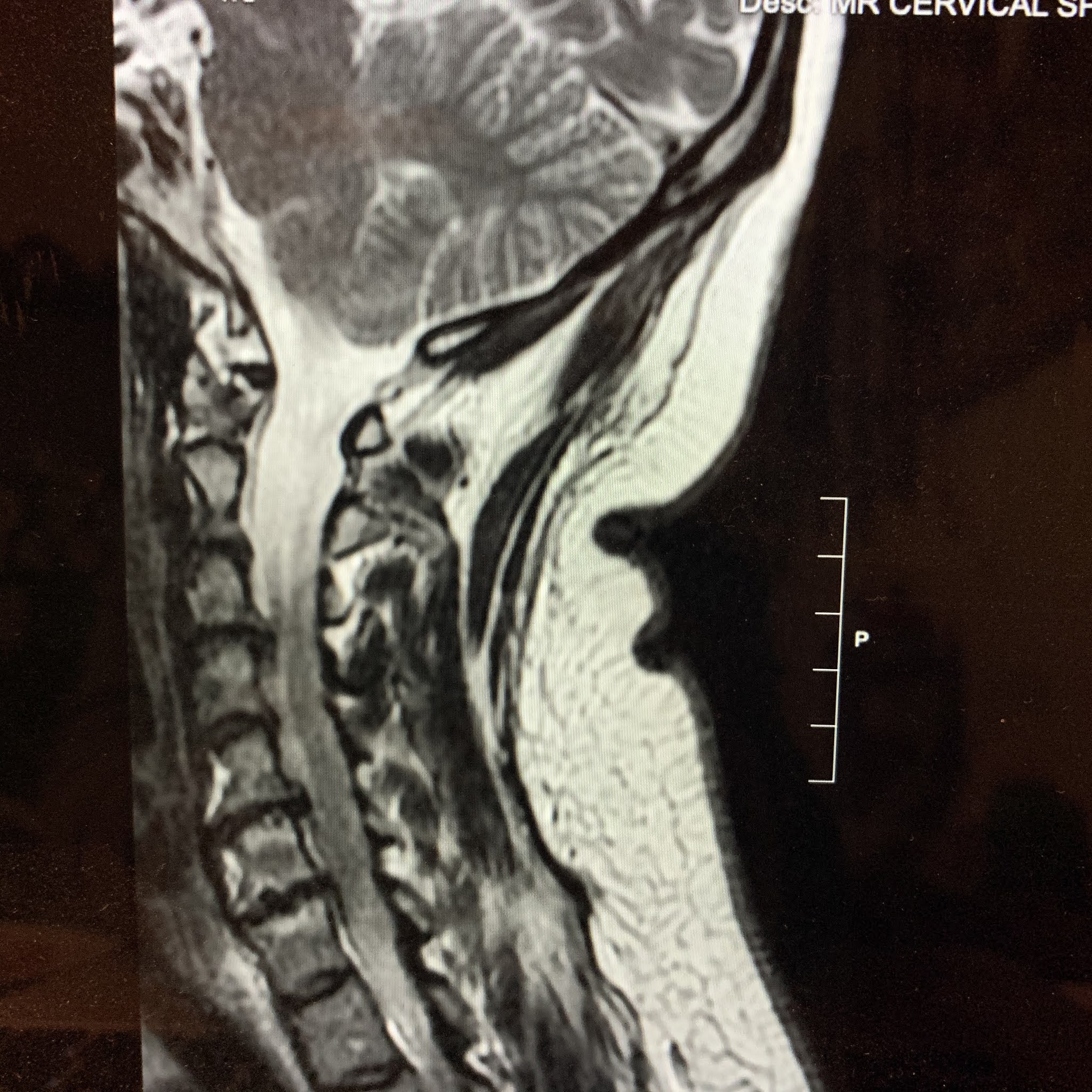 Team Tsunami: Final-ish Report on my Cervical MRI