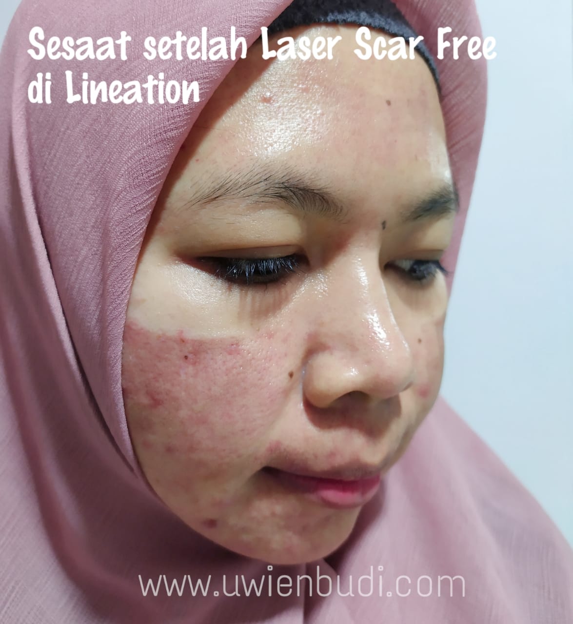 Pengalaman Laser Menghilangkan Bekas Jerawat Di Lineation Clinic Uwien Budi