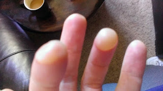 guitar injury