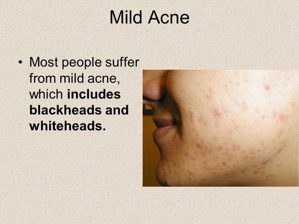 Acne Every Women's Dreams