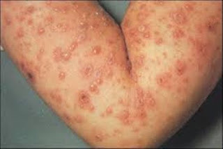 Obat Gatal Ryzen, Gatal Eksim Infantil, Obat Gatal Di Selangkangan Cowo, Obat Salep Gatal Eksim Basah, Obat Gatal Di Selangkangan Yang Tersedia Di Apotik, Gatal Eksim Sembuh Total, Obat Alami Gatal Gatal Pada Kaki, Penyakit Eksim Pada Kulit Kepala, Gatal Di Bagian Selangkangan Paha, Gatal Eksim Menular, Obat Gatal Bernanah Dan Berair, Obat Gatal Gatal Pada Kulit Herbal, Obat Alami Gatal Di Selangkangan, Obat Alami Untuk Gatal Gatal Di Seluruh Badan, Tanaman Obat Gatal Pada Kulit, Obat Menghilangkan Rasa Gatal Pada Selangkangan, Gatal Di Selangkangan Karena Diabetes, Eksim Di Jari Kaki, Obat Gatal Gatal Di Tangan Dan Kaki, Rasa Gatal Di Rambut Kemaluan, Penyakit Eksim Basa, Salep Gatal Eksim Kering Untuk Anak, Mengatasi Penyakit Kulit Eksim, Obat Gatal Mujarab Tradisional, Obat Luar Eksim Kering