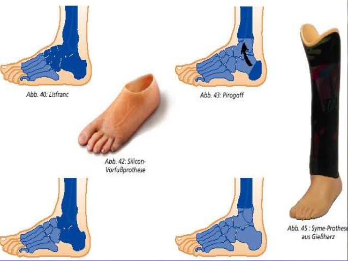 Blogão de Fisio: AMPUTAÇÃO