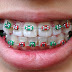 Các phương pháp niềng răng người lớn phổ biến