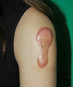 obat keloid untuk anak