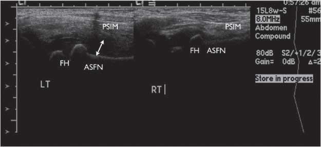 Ultrasound demonstrating a left hip effusion