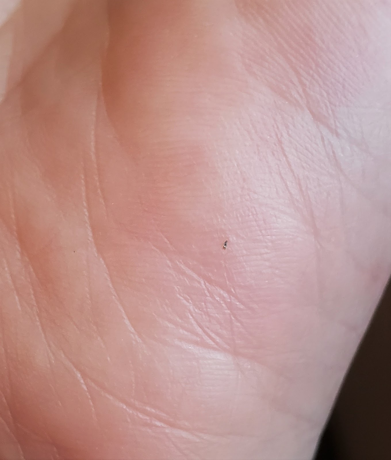 Wasp Sting Reaction, Treatment, Remedy and Black Dot from a Wasp Sting