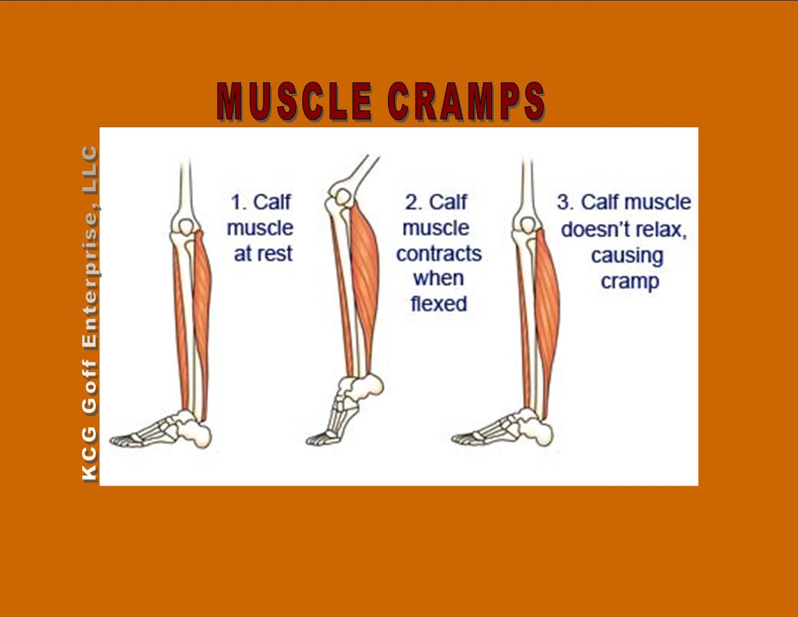 Обхват икроножной мышцы. Виды икроножных мышц. Cramps of the Calf muscles,. На что похожа икроножная мышца. Cramps перевод