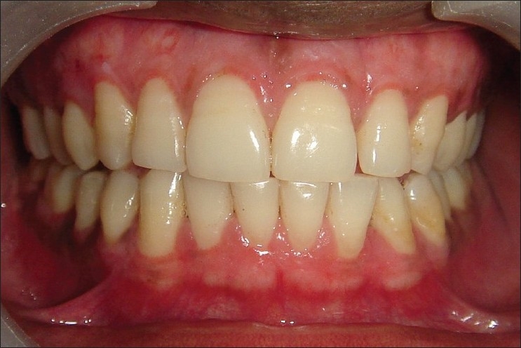 kaplama dislerde diseti renklenmesi