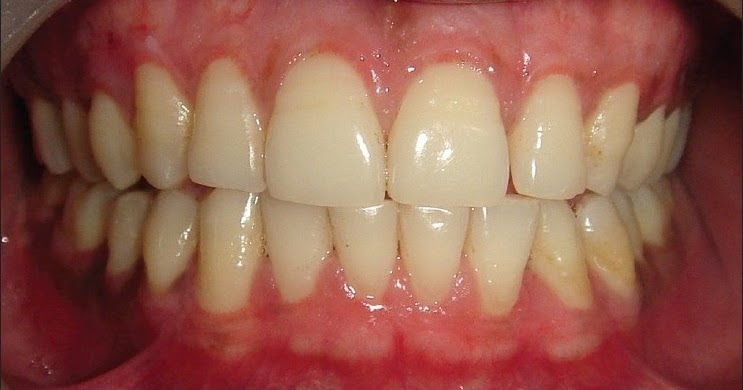 Kaplama dişlerde dişeti renklenmesi neden olur?