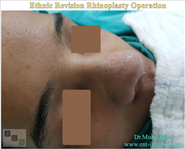 Ethnic Revision Nose job in Istanbul,Ethnic Revision Rhinoplasty Istanbul,Complicated Revision Rhinoplasty,