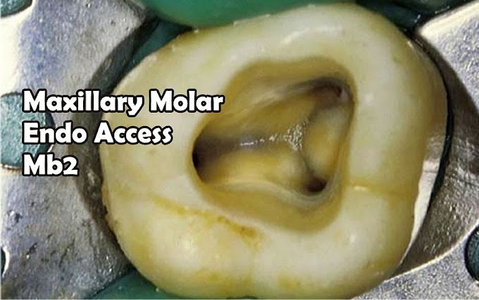 ROOT CANAL: Maxillary Molar Access - Finding MB2