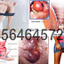 Jenis Obat Wasir Online Tanpa Resep Dokter Anorektal thumbnail