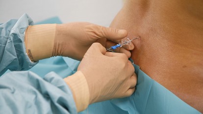 Epidural Injectio