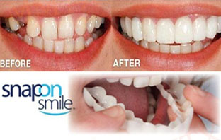 ابتسامة هوليوود المتحركة في الرياض سعرها ومميزاتها