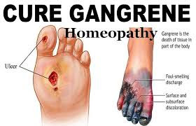 Gangrene