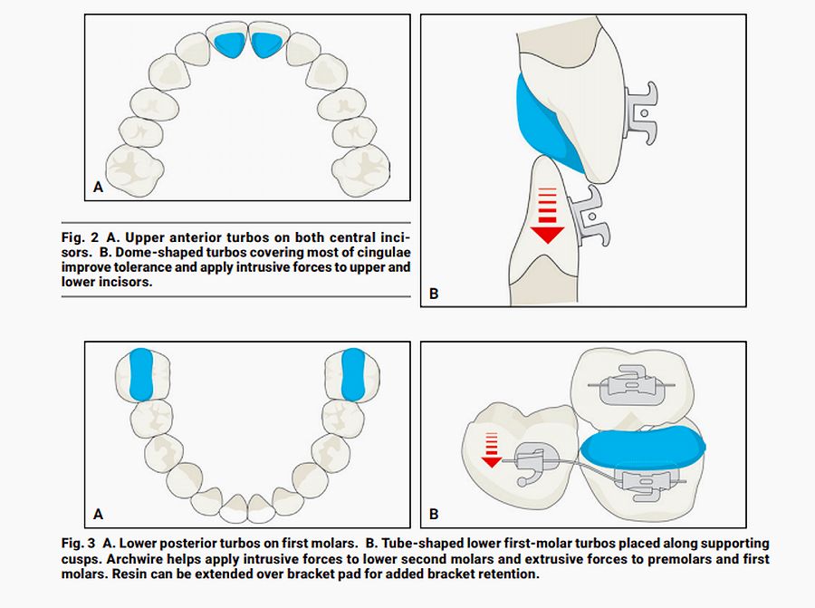 PDF Resin Bite Turbos