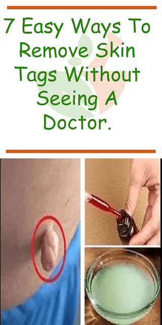7 Easy Ways to Remove Skin Tags Without Visiting a Doctor