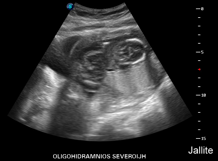 Higroma Quistico & Oligohidramnios & Obito