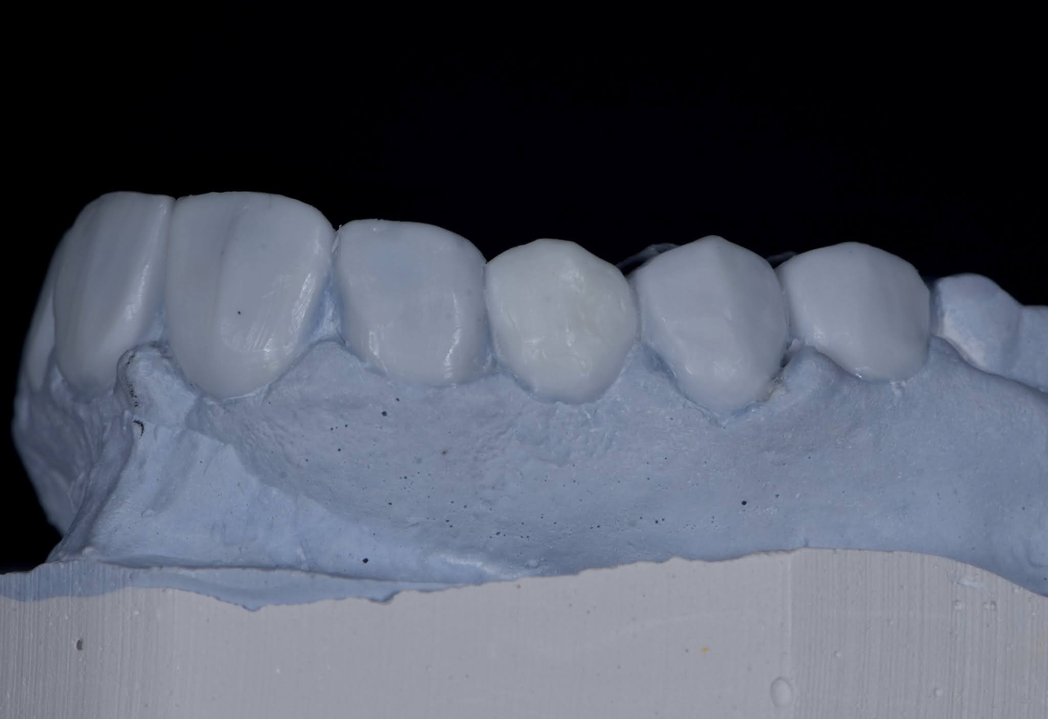 Dental Esthetics Ovate pontic for the correct emergence profile.. A clinical case