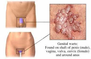 Obat Penyakit Jengger Ayam Obat Penyakit Jengger Ayam