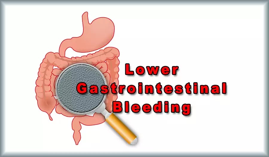 Lower gastrointestinal bleeding: causes, investigations, management