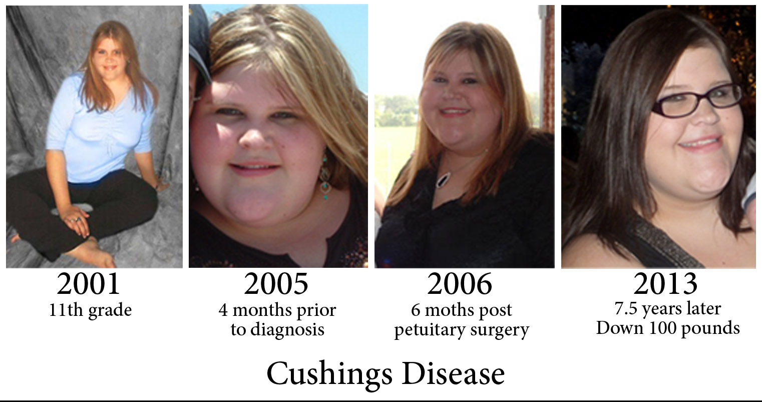 A Little Less Mommy: Cushing's Disease