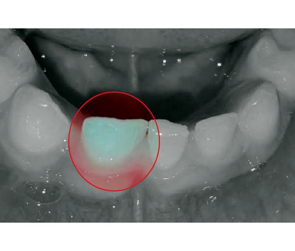 Anomalías dentarias de unión Fusión y Geminación en dentición primaria