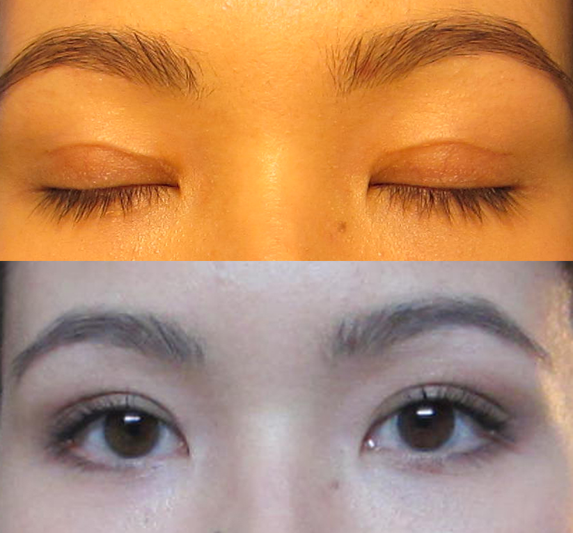 before and after eyelid tape