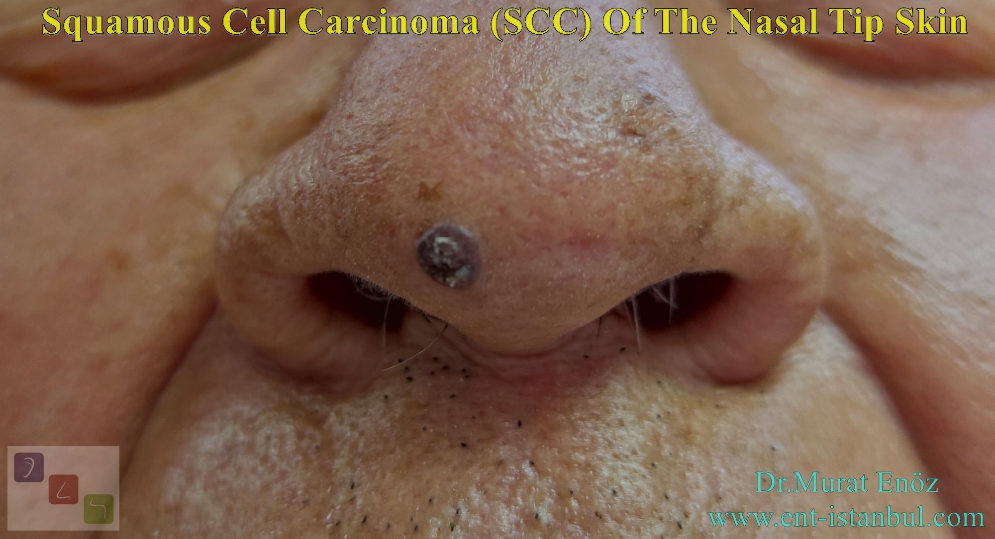 Squamous Cell Carcinoma (SCC) Of The Nasal Tip Skin