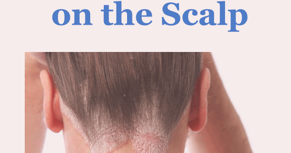 eczema treatment for scalp eczema treatment for scalp