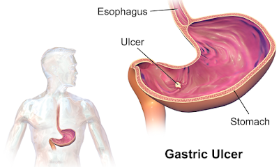 Gastric Ulcer - actual Cause and Remedy